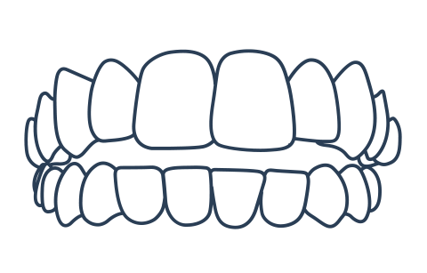 Open bite example for Invisalign